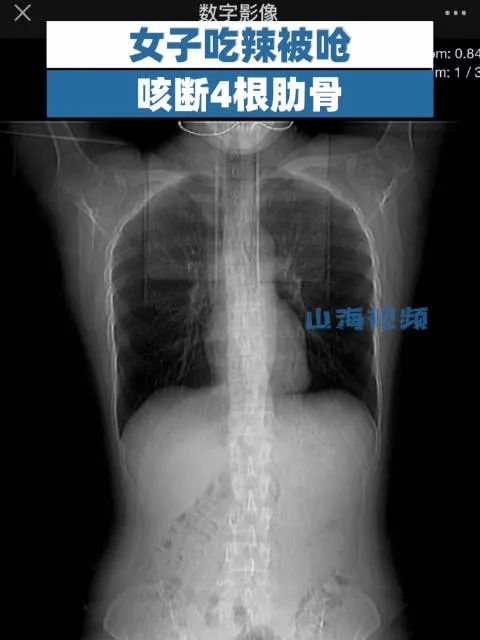 上海一女子吃辣被呛，咳断4根肋骨？报出体重惊呆众人…