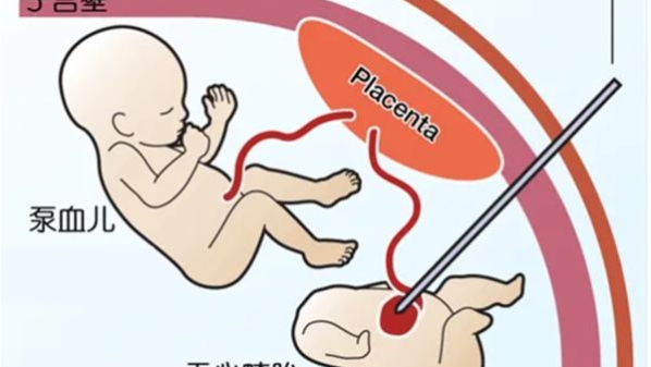 双胎妊娠遇上“无心胎”，国妇婴医护接力完成宫内急救