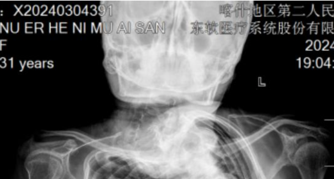 填“空”行动  喀什二院实施南疆首例高难度脊柱侧弯矫形手术！