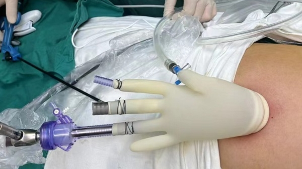 将3厘米切口“藏”在肚脐里 他们成功为患者动了台“钥匙孔”手术