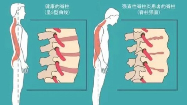 这一疾病主要影响年轻人！上海专家揭示强直性脊柱炎原发病变部位内部细胞图谱