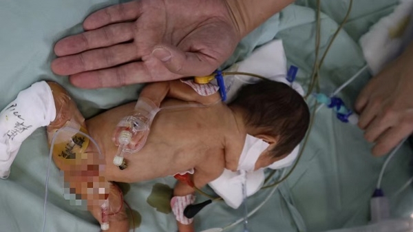 低体重袖珍早产宝宝遭遇食管闭锁 新华医院专家用米粒大小胸腔镜创医学新纪录