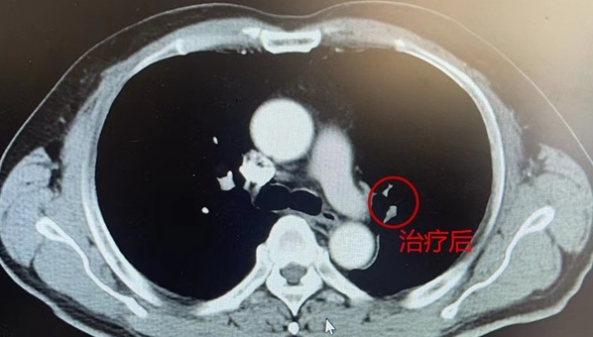 “新辅助+手术”夹击，让中晚期肺癌无所遁形