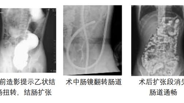 初三男孩体育课后突腹痛，居然是肠子“打了结”