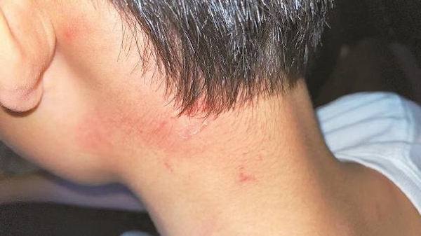 夏令热线 | 密室游戏“惊魂”一刻 铁门卡脖男孩受伤