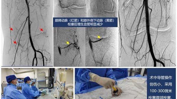 缓解老年性关节疼痛 介入栓塞为骨性关节炎提供治疗新方案