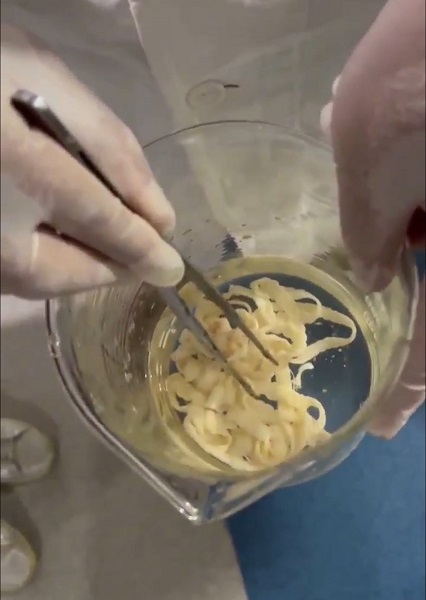 女子体内排出10米长绦虫！原是两年前旅游吃了特色生牛肉中招